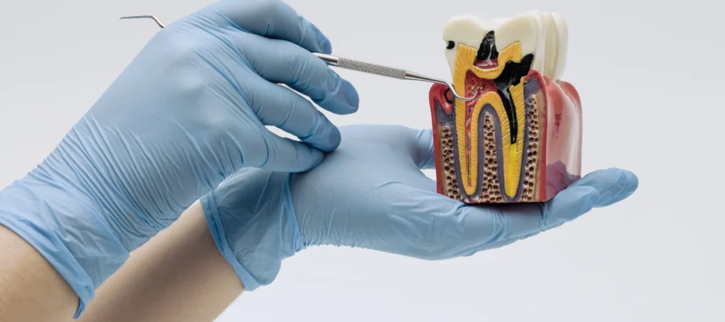Root canal treatment near me